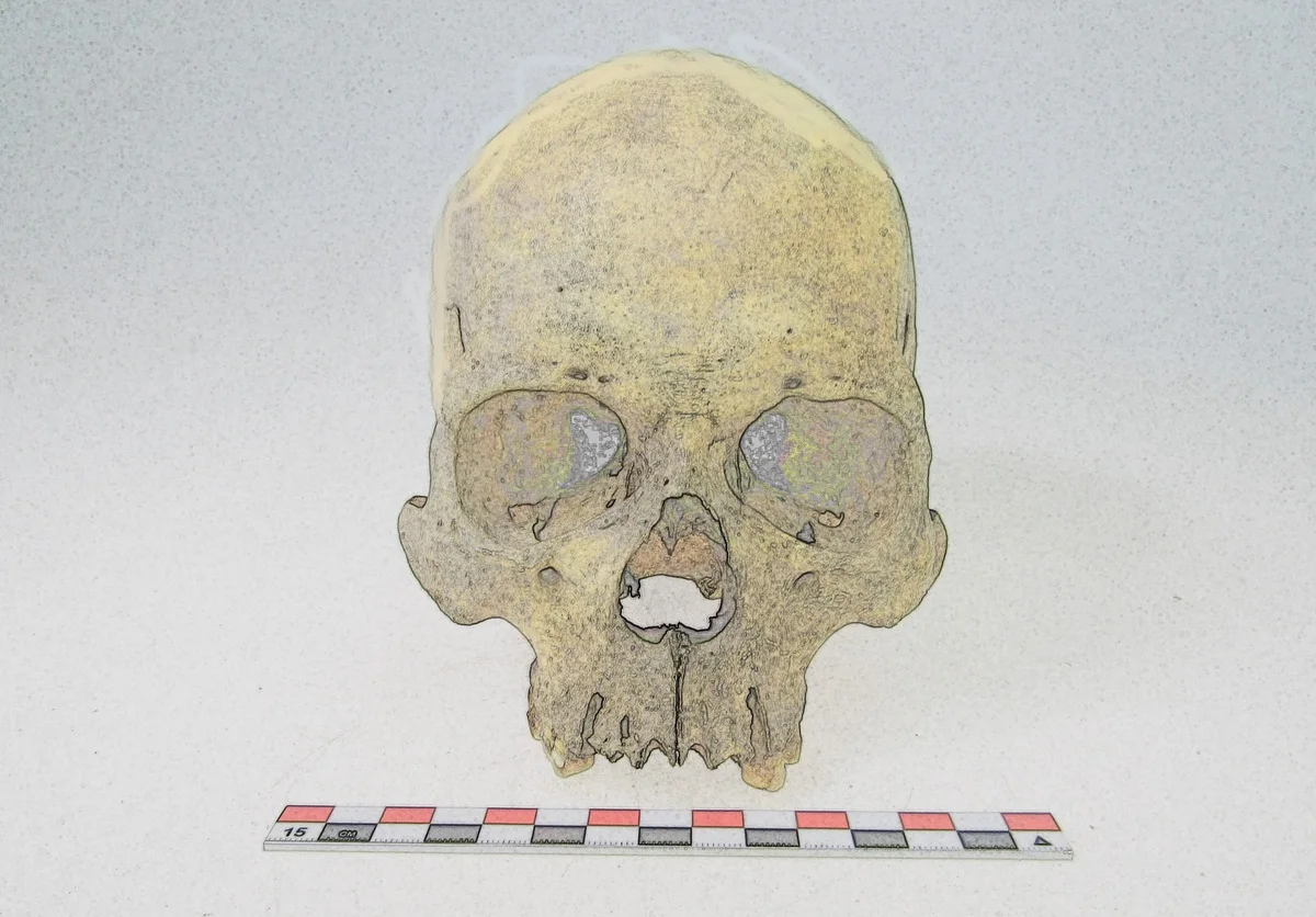 Descubren rastros de lepra de hace 4000 años en América gracias al análisis de ADN antiguo